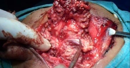 Parotid Surgery live video by Dr.Santanu Bhattacharjee Kolkata 2016